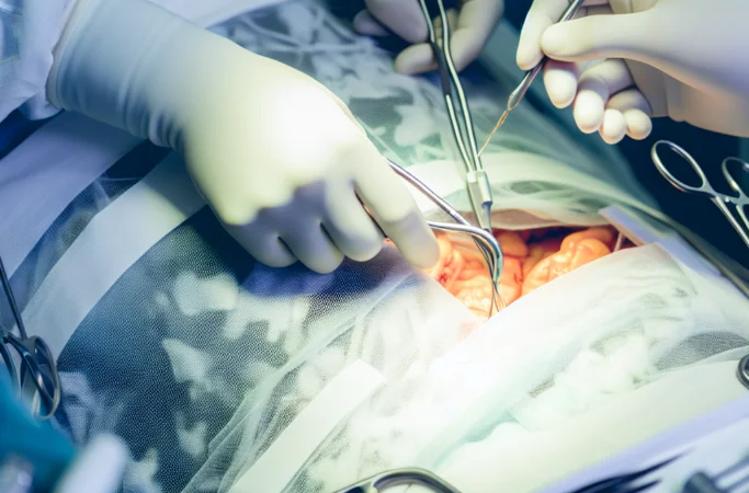 Total Abdominal Colectomy Shows Promise for Ulcerative Colitis: What This Means for Your Treatment Journey