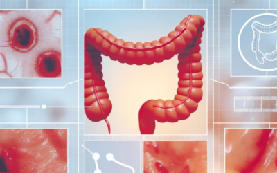 Managing Perianal Disease in Crohn's: A Comprehensive Guide to Fistulas, Abscesses, and Fissures