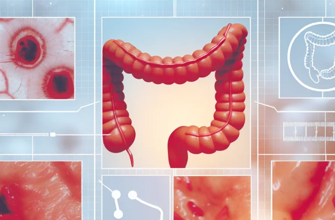 Managing Perianal Disease in Crohn's: A Comprehensive Guide to Fistulas, Abscesses, and Fissures