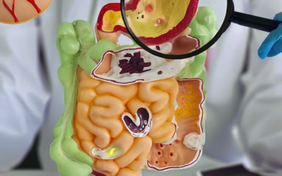 Global IBD Cases Surge: What New Research Means for Your Health Journey