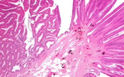 New Research Reveals Critical Differences in Cancer Risk from IBD-Related Precancerous Lesions
