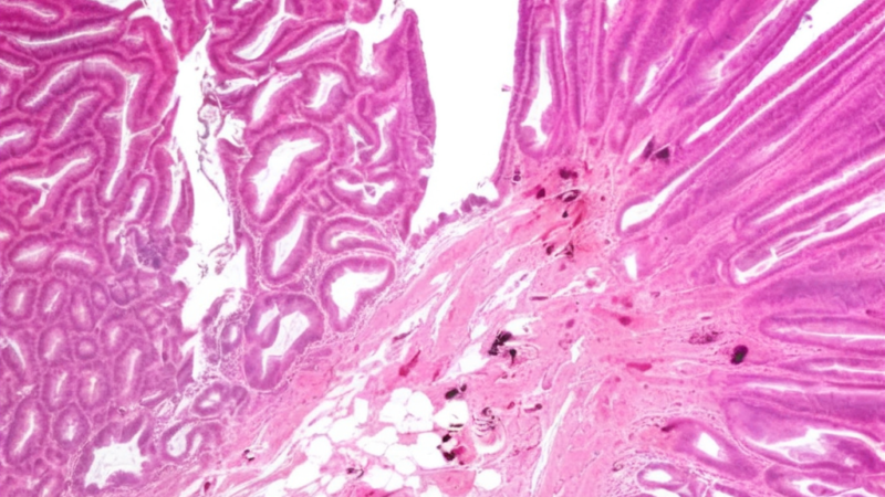 New Research Reveals Critical Differences in Cancer Risk from IBD-Related Precancerous Lesions