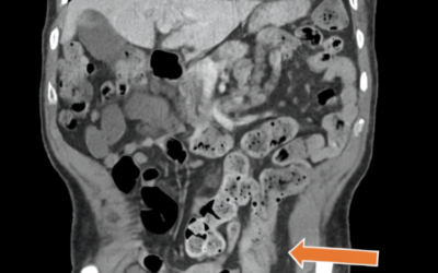 When Crohn's Disease Masquerades as Another Condition: A Critical Lesson in Accurate Diagnosis