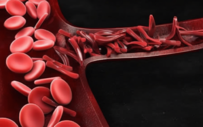 New Study Reveals Alarming Anemia Rates in IBD Patients: What This Means for Your Health Journey