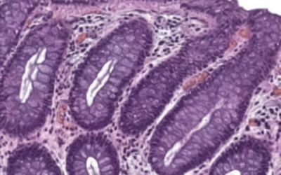 New Case Study Reveals Why Capsule Endoscopy Could Be a Game-Changer for Early Crohn's Diagnosis